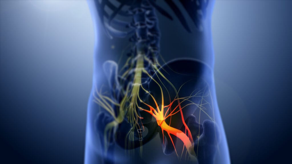 What Is Sciatica